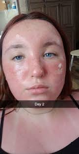 Oddly, I find sunburns attractive.....and appeeling…..