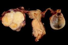 This type of pain occurs when the lymph nodes in the pelvis or cervical cancer tumor encroach on the renal collecting system. Cervical Cancer Practice Essentials Background Pathophysiology