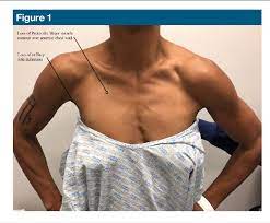 The pectoralis major, a large muscle of the upper chest wall, arises from the breastbone (sternum), the collarbone (clavicle), and cartilages of the second to the sixth ribs; Pdf Pectoralis Major Rupture In An Active Female Semantic Scholar