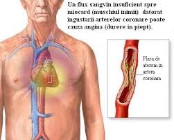 Ischemică coronariană este o afecțiune care se manifestă clinic prin dureri anginoase,cauzate de insuficienta oxigenare a celulelor miocardice; Poze Medicale Cardiopatia Ischemica Angina Pectorala Si Infarctul Miocardic