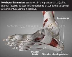 Bone spurs (also called osteophytes) are smooth, hard bumps of extra bone that form on the ends of bones. Comparing Injection Treatments For Plantar Fasciitis Plantar Fasciopathy And Plantar Fasciitis Tears Caring Medical Florida
