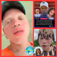 Kou a di wi dan la repiblik😂 Yon #Albinòs ayisyen nan Sendomeng fè tèt li  pase pou #antreprenè ameriken, li arrive kouche yon dominikèn nan premye  randevou yo, li te dil li