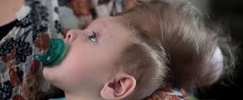 Boy Born With Brain Growing Outside of His Skull