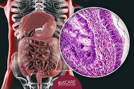 How common is colorectal cancer? Why You Shouldn T Skip Regular Colon Cancer Screening