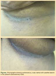 Image result for Intertrigo under breasts