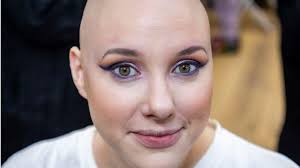 Essex woman with alopecia appears at London Fashion Week