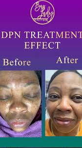 What are those little dark spots? It maybe DPN. , The dermatological term  for DPN is Dermatosis Papulosa Nigra. They are benign epidermal growths  that occur primarily in Black and Asian skin. , Text ...