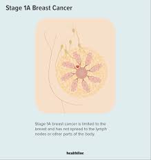 Image result for Breast Cancer Management
