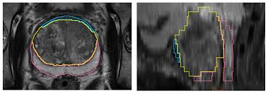 Find the information you need today. Prostatex Zone Segmentations Prostatex Seg Zones Tcia Dois Cancer Imaging Archive Wiki