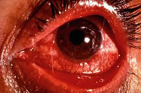 Image result for Acute Red Eye