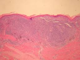 Melanoma Pathology Dermnet Nz