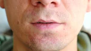 I started developing this about a year ago. Skin Irritation After Shaving Pimples Stock Footage Video 100 Royalty Free 1007994880 Shutterstock
