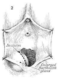 Image result for Bartholin's gland abscess