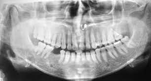 Osteosarcoma is the most common type of cancer that begins in you or your teenager's bones, usually in the arms or legs. Jcdr Osteoblasts Osteosarcoma Jaws Mandible