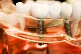 However if you choose to get your treatment done at bpi dental you do not need to be concerned about which system to use or its associated cost. Dental Implants Things You Should Know Kitchener Dentist Kyle Hornby