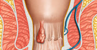 أعراض البواسير الداخلية تعرف عليها ويب طب