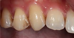 Coffee and tea stains occur when tannins in both of them build up on tooth enamel. Cavity Vs Stain Is It A Black Spot A Hole Or A Crack