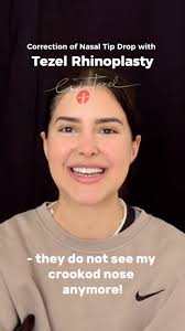 İzsiz Kıkırdak Tespiti ile burna dışarıdan kesi yapmadan burna şekil verme  * Rhinoplasty procedures provide more natural results and reduce the need  for second surgeries for patients using the traceless cartilage fixation