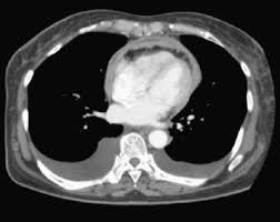They can also help determine the stage ( . Surgical Experience Of Pericardial Mesothelioma Presenting As Constrictive Pericarditis Sciencedirect