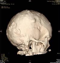 Image result for Gardner Sendromu