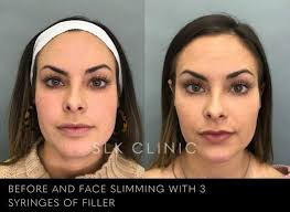 Before and After Photos of Fillers in Nashville