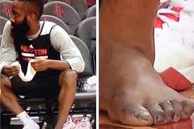 James Harden S Left Foot Has Some Nasty Looking Toes Bleacher Report Latest News Videos And Highlights