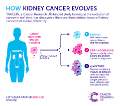Some kidney cancers, even some which are advanced and have spread, respond much better to immunotherapy than others. Piecing Together Kidney Cancer Evolution Cancer Research Uk Cancer News