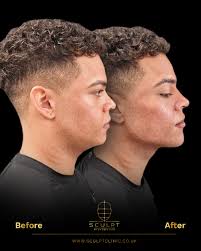 ✨ Male Profile Balancing Introducing undetectable balance to the male face  in a matter of minutes with carefully placed dermal fillers. 🙌 Book your  treatment or training now! 📞07457411430  🌐https://sculptclinic.aesthetidocs.app 📝https ...