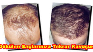 Sac Dokulmesi Nedir Samsun Gezi Ve Yasam Portali