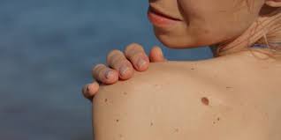 14.08.2019 · signs and symptoms of melanoma skin cancer. What Is Basal Cell Carcinoma Treatment Symptoms And Causes