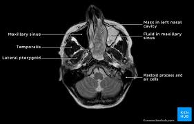 The nasal cavity also contains structures to detect chemical odorants and resonate the voice. Schwannoma Of The Nasal Cavity Clinical Case Diagnosis Kenhub