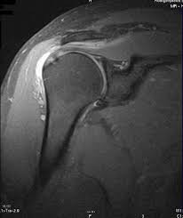 Bdt Impingement Syndrom Der Schulter