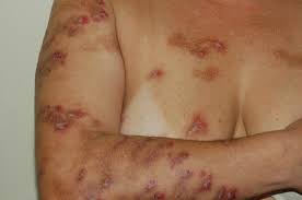 Image result for Neurotic Excoriation