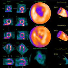 Image result for Nuclear Ventriculogram