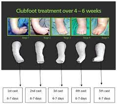 Any infant born with clubfoot should be taken to an. Orthobullets The Ponseti Method Of Serial Manipulation Facebook