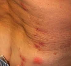 La piqûre de punaise de lit est semblable a celle d'un moustique, mais elle se caractérise par sa couleur rouge, qui est bien plus vive. Piqures De Punaises De Lit Symptomes Patrice Mure