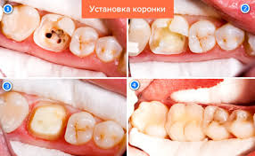 Это и керамика, и диоксид циркония. Metallokeramicheskaya Koronka Na Zub V Tyumeni Ceny Na Zubnye Koronki Iz Metallokeramiki Pod Klyuch
