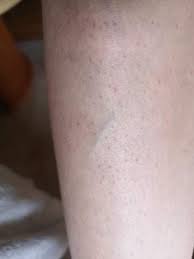 Sind Das Schon Krampfadern Schmerzen Gesundheit Medizin