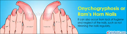 onychogryphosis or ram s horn nails