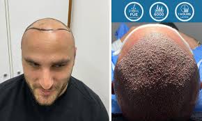 Do you suffer from hairloss? 6000 Greft Fue Method Hair Transplant Hair Transplant Grafting Hair