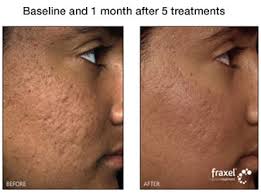 Bella leon permanent hair removal. Fraxel Wyndhurst Aesthetics