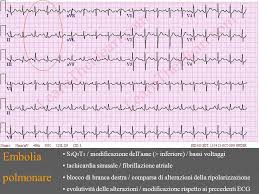 3) embolia polmonare a rischio basso (non massiva): Miocardiopatie Farmaci Disionie Ppt Video Online Scaricare
