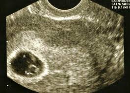 Ultrasound pictures of twins provide that intriguing first glance at multiple life in the womb. Noelle And Eden Ttts Parents