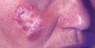 * forma verrugosa = acantosis, hiperqueratosis e infiltrado abundante en la. Tuberculosis Cutis Luposa Zdravlje