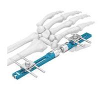 External Fixator For Wrist And Forearm,Medical Device ...