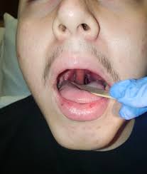 Image result for Peritonsillar Abscess