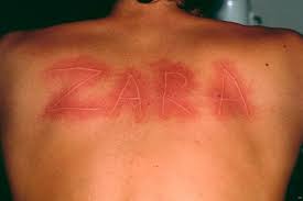 Image result for Dermatographism