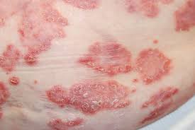 Image result for koebner phenomenon psoriasis