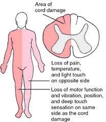 Brown Sequard Syndrome Spinal Cord Injury Spinal Cord Spinal Cord Injury Nursing