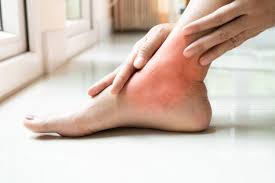 Bone cancer develops in the skeletal system and destroys tissue. Ankle Discoloration Causes And Treatment Options Clement Banda Md Dermatologist